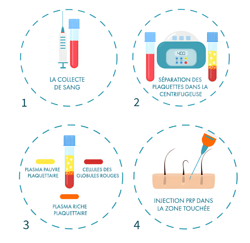 Médecine esthétique Nouvelle technique au cabinet : le PRP capillaire | Médecine Esthétique Lyon
